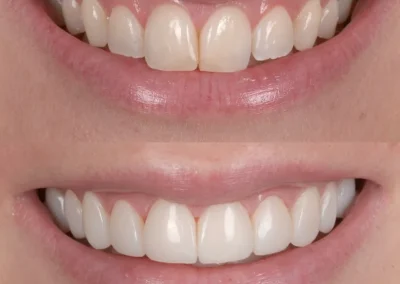 Teeth alignment by braces - before & after