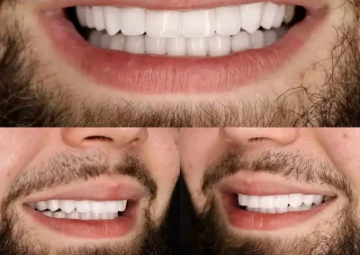 Teeth bone graft for full mouth- before & after