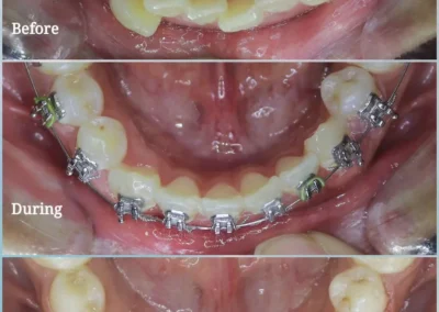 Teeth extraction for crowding treatment at Rincon Family Dentistry in Tucson- before & after