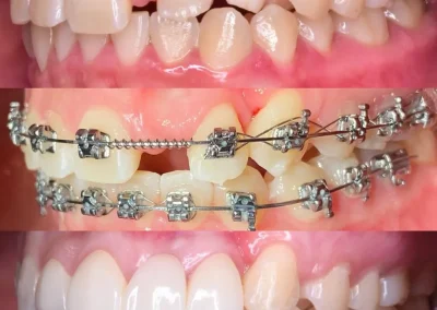 Teeth extraction for impacted canine teeth - before & after