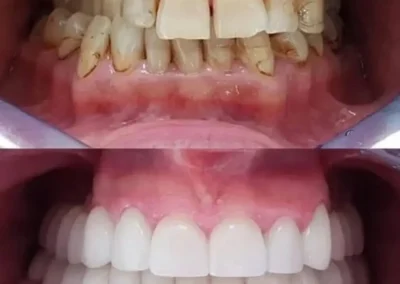 Teeth scaling and polishing - before & after
