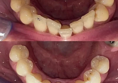 Teeth straightened by braces treatment at Rincon Family Dentistry Tucson -Before & after