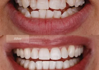 Transparent Clear Aligners-Before & After