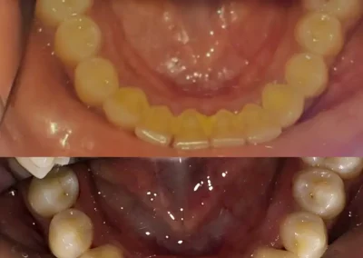 Ultrasonic teeth scaling-before & after
