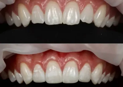 best cosmetic dental bonding by rincon family dentistry