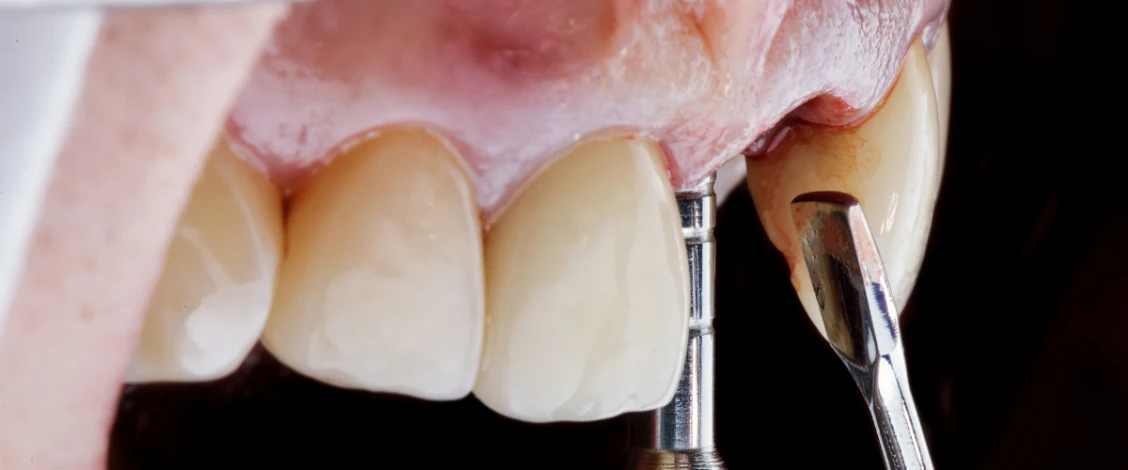 bone grafting