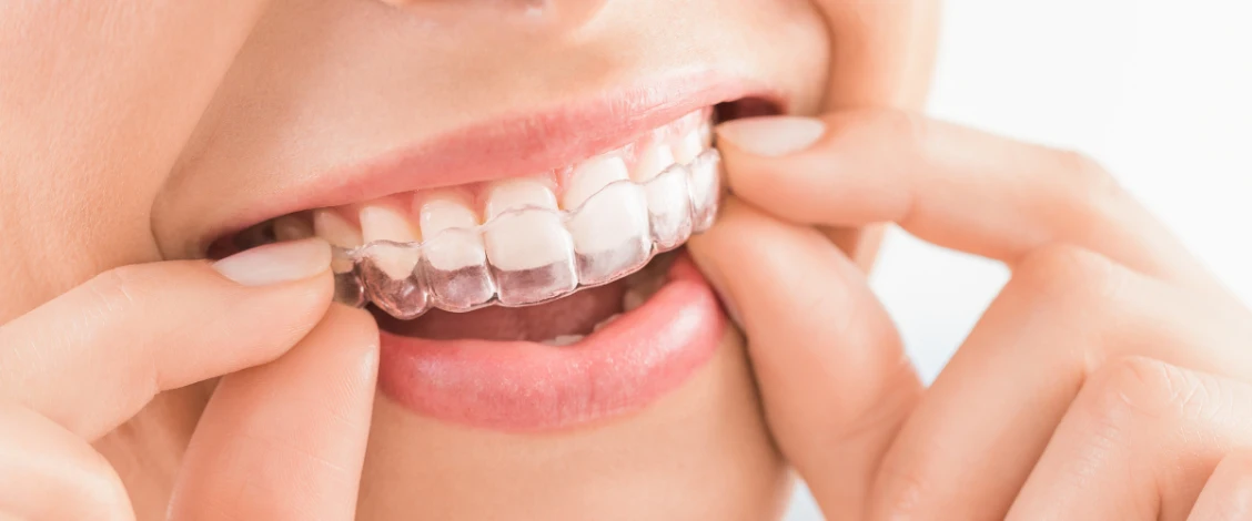 clear aligners