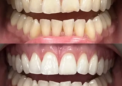 composite veneer bonding for tooth restoration