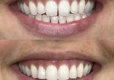 dental bonding resin application on tooth