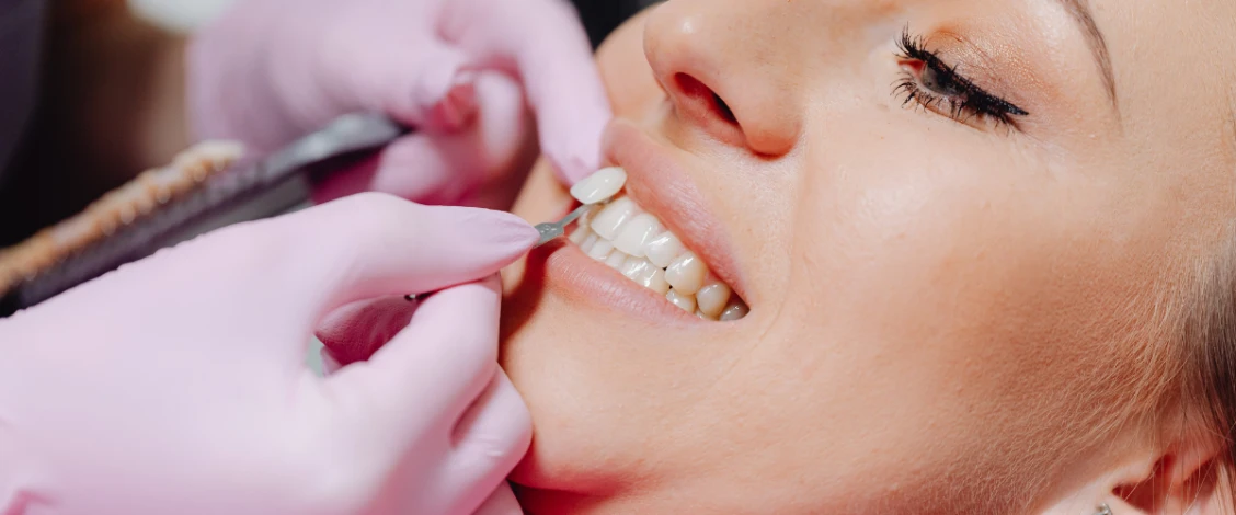 dental veneers
