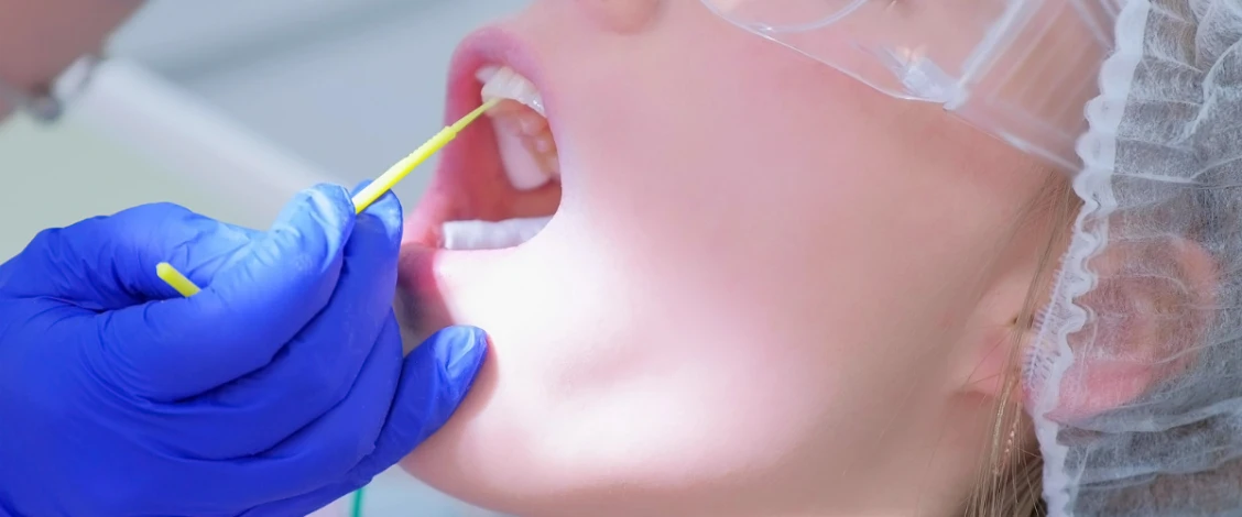 fluoride treatment