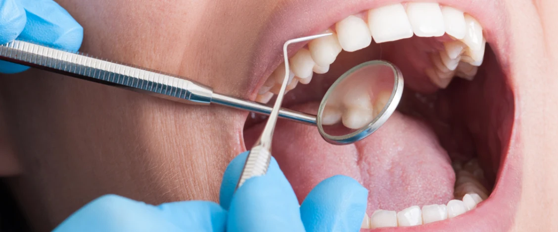 teeth bonding