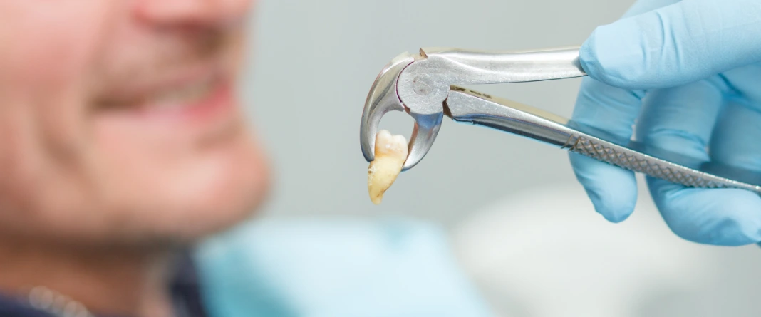 tooth extraction