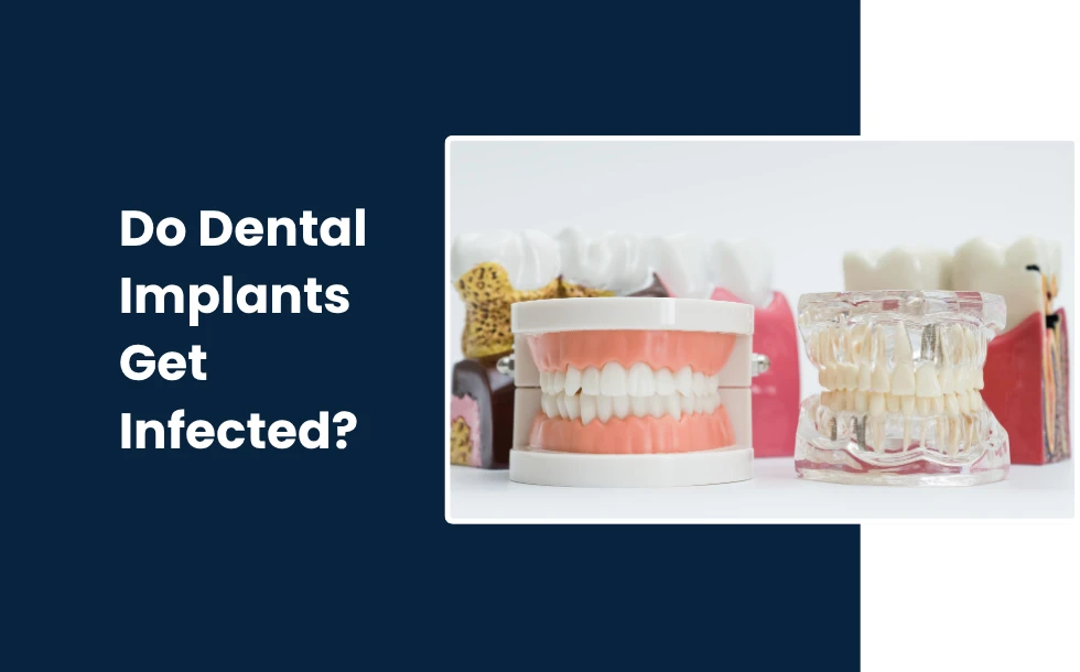 Do Dental Implants Get Infected A Complete Guide