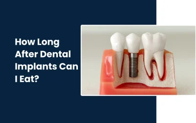 How Long After Dental Implants Can I Eat?