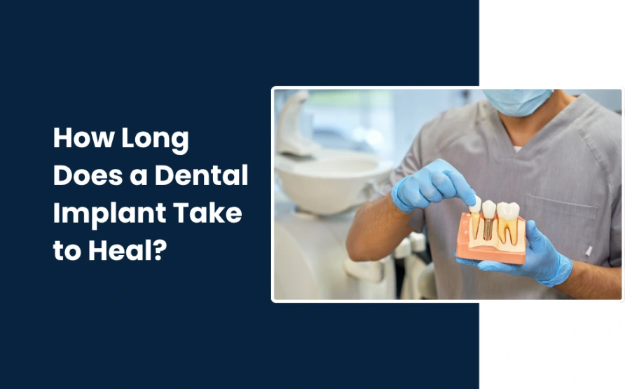 How Long Does a Dental Implant Take to Heal-Full Timeline Guide