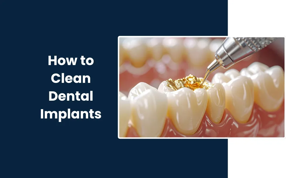 How to Clean Dental Implants Different Steps and Methods