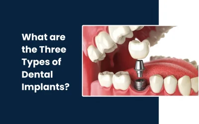What Are the 3 Types of Dental Implants?