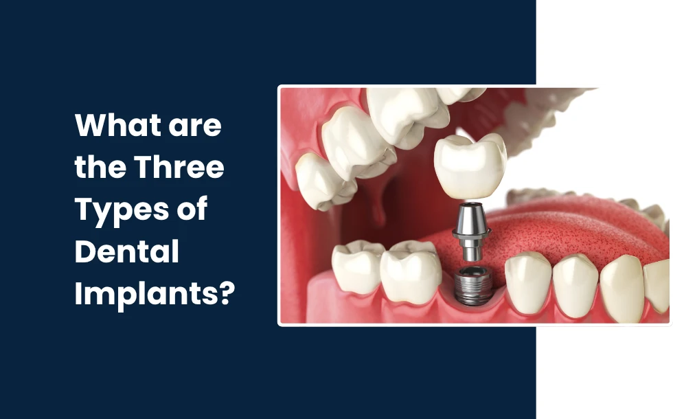 What are the Three Types of Dental Implants