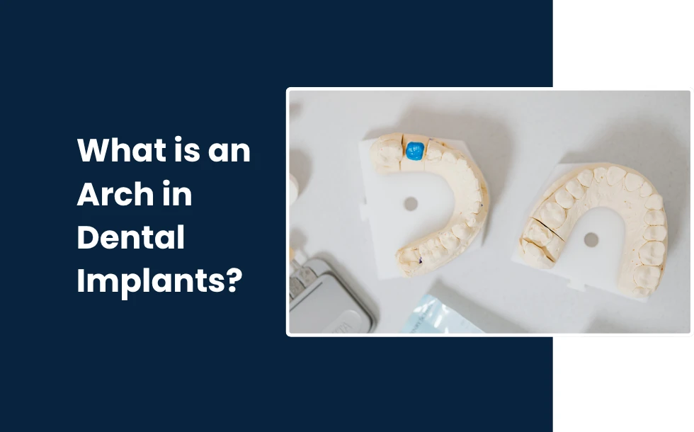 What is an Arch in Dental Implants-A complete guide to understand
