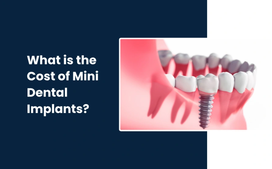 What is the Cost of Mini Dental Implants