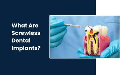 What Are Screwless Dental Implants? How Do They Work
