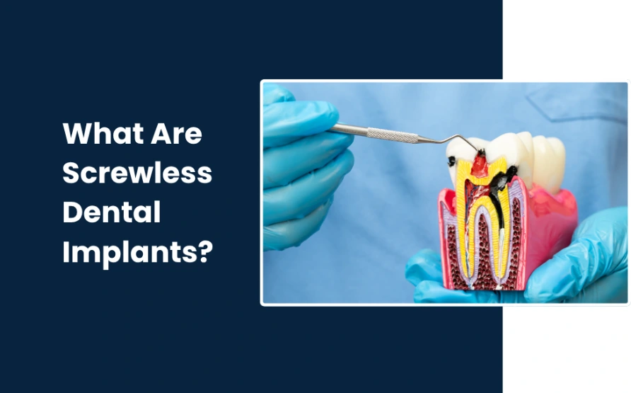 what are screwless dental implants