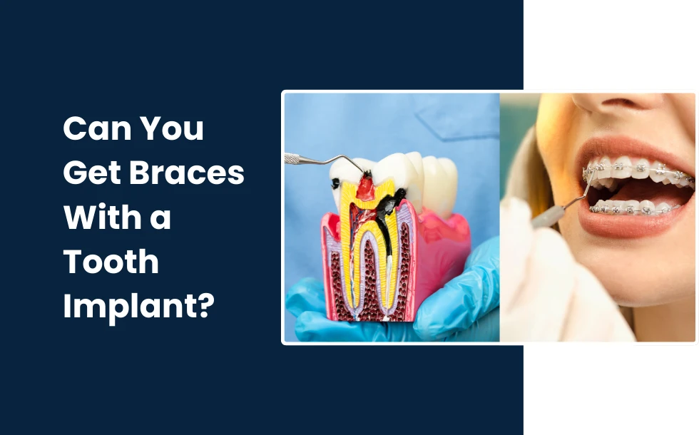 Can You Get Braces With a Tooth Implant - A comprehesive guide