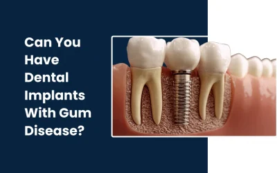 Can You Have Dental Implants With Gum Disease?