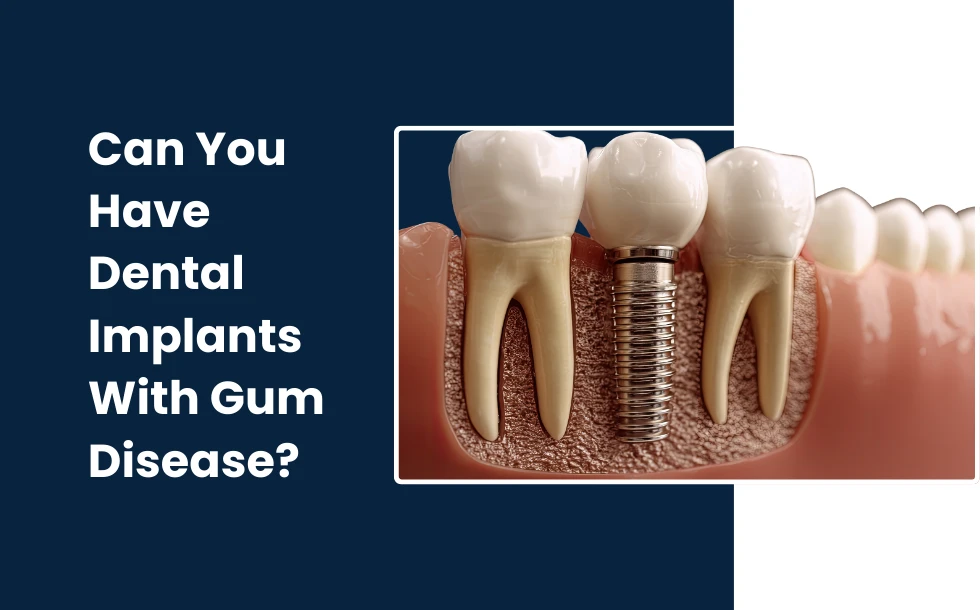 Can You Have Dental Implants With Gum Disease - A comprehesive guide