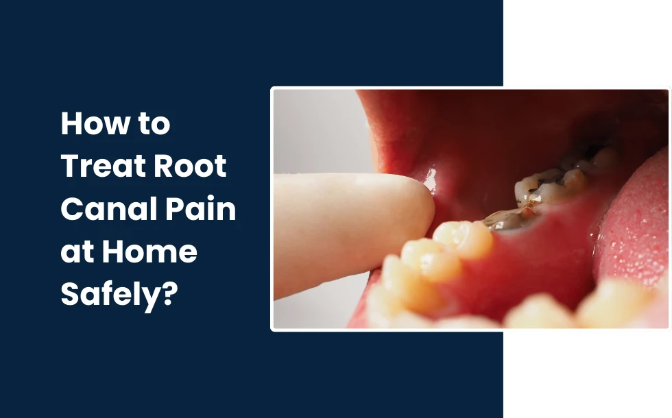 How to Treat Root Canal Pain at Home Safely - A comprehesive guide