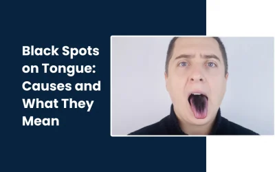 Black Spots on Tongue: Causes and What They Mean