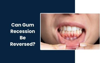 Can Gum Recession Be Reversed?