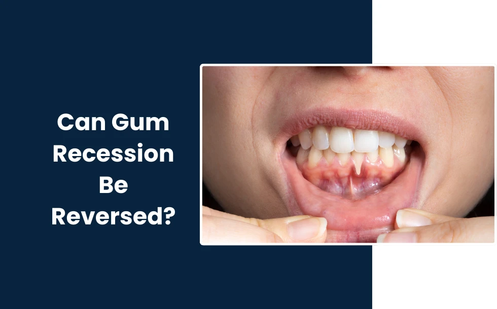 Can Gum Recession Be Reversed - A comprehesive guide
