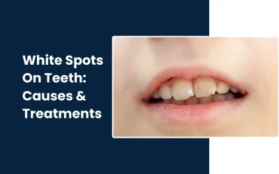 White Spots On Teeth: Causes and How to Get Rid of Them